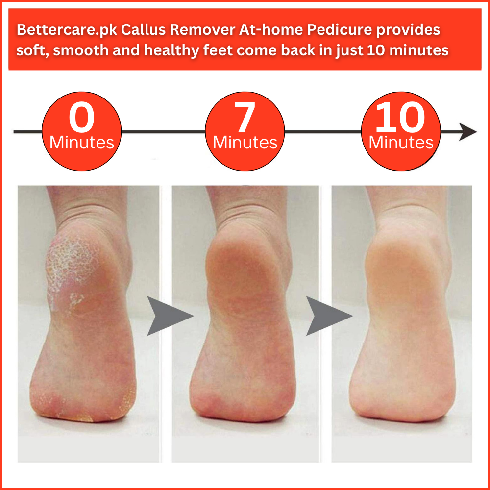 Callus Remover At-home Pedicure