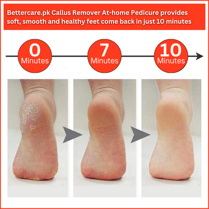 Callus Remover At-home Pedicure